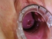 Busty Jenny extreme pussy gaping on gyno chai 13/16